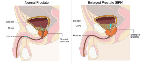 What does it mean to have an enlarged prostate? 